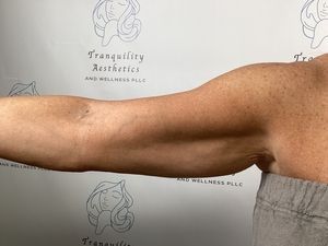 Side view of a toned upper arm and torso in a neutral studio backdrop with clinic logo