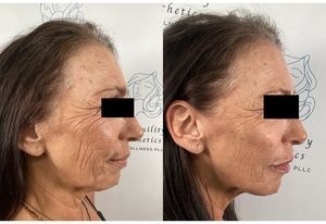 Side-by-side profile photos showing facial wrinkles before and after cosmetic treatment