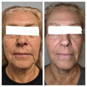 Side-by-side front-facing facial photos of a person, with white bars covering the eyes.