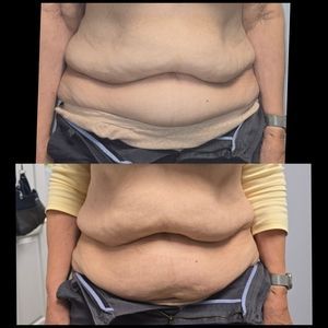 Front-view torso comparison photo showing abdominal skin folds before and after.