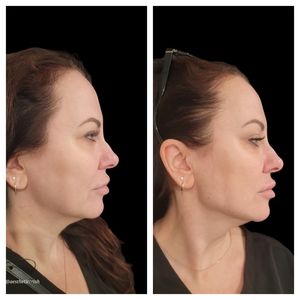 Side-by-side profile photos of a woman before and after facial profile changes on a black background