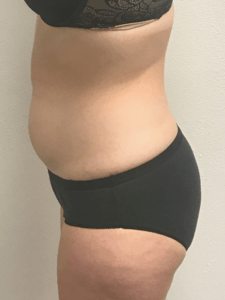 After Treatment Side View — Pensacola, FL — Physicians Cosmetic & Laser Center After Treatment Side View — Pensacola, FL — Physicians Cosmetic & Laser Center