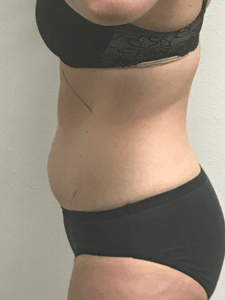 Abdomen Treatment Side View — Pensacola, FL — Physicians Cosmetic & Laser Center Abdomen Treatment Side View — Pensacola, FL — Physicians Cosmetic & Laser Center
