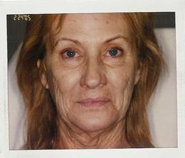 Before Feather Lift — Pensacola, FL — Physicians Cosmetic & Laser Center Before Feather Lift — Pensacola, FL — Physicians Cosmetic & Laser Center