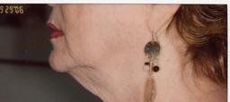 Before Skin Firming — Pensacola, FL — Physicians Cosmetic & Laser Center Before Skin Firming — Pensacola, FL — Physicians Cosmetic & Laser Center