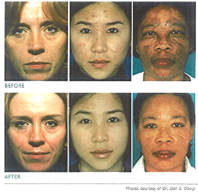 Before And After Skin Care — Pensacola, FL — Physicians Cosmetic & Laser Center Before And After Skin Care — Pensacola, FL — Physicians Cosmetic & Laser Center