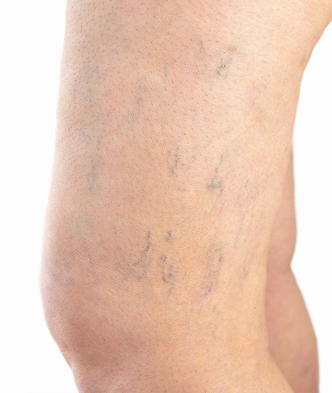 Spider Veins — Pensacola, FL — Physicians Cosmetic & Laser Center Spider Veins — Pensacola, FL — Physicians Cosmetic & Laser Center
