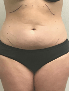 Abdomen Treatment — Pensacola, FL — Physicians Cosmetic & Laser Center Abdomen Treatment — Pensacola, FL — Physicians Cosmetic & Laser Center
