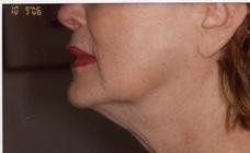 After Skin Firming — Pensacola, FL — Physicians Cosmetic & Laser Center After Skin Firming — Pensacola, FL — Physicians Cosmetic & Laser Center