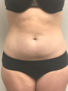 After Abdomen Treatment — Pensacola, FL — Physicians Cosmetic & Laser Center After Abdomen Treatment — Pensacola, FL — Physicians Cosmetic & Laser Center
