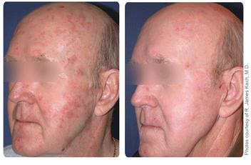 Profractional Therapy — Pensacola, FL — Physicians Cosmetic & Laser Center