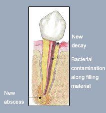 Fix tooth pain with our emergency root canal retreatment surgery in Overland Park KS Image explaining root canal retreatment | Fix your tooth pain in Overland Park KS 66209