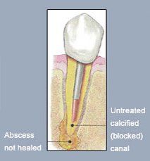 Fix tooth pain with our root canal retreatment surgery in Overland Park KS. Abscess in Tooth that is not healed with blocked canal | Root canal specialist in Overland Park KS