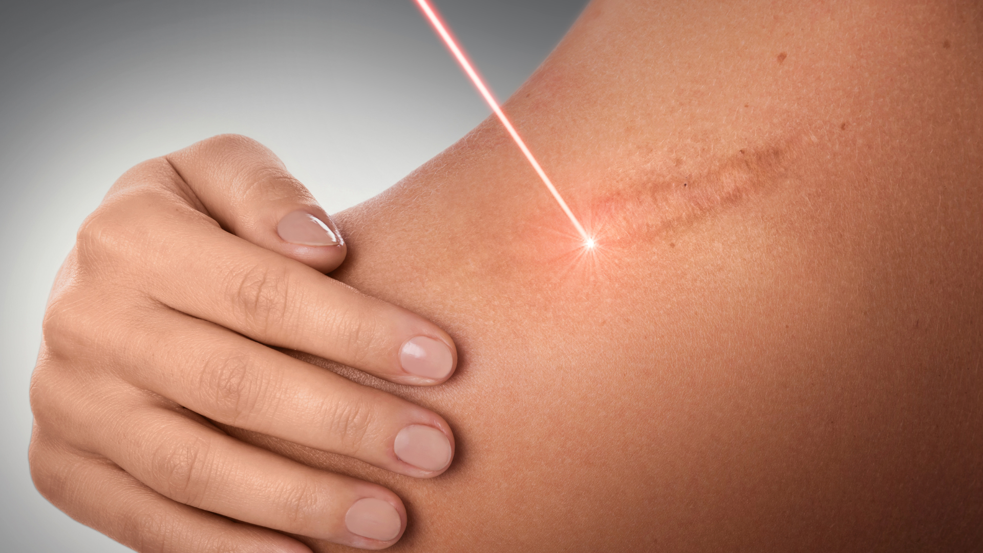 A person is getting a laser treatment on their arm.