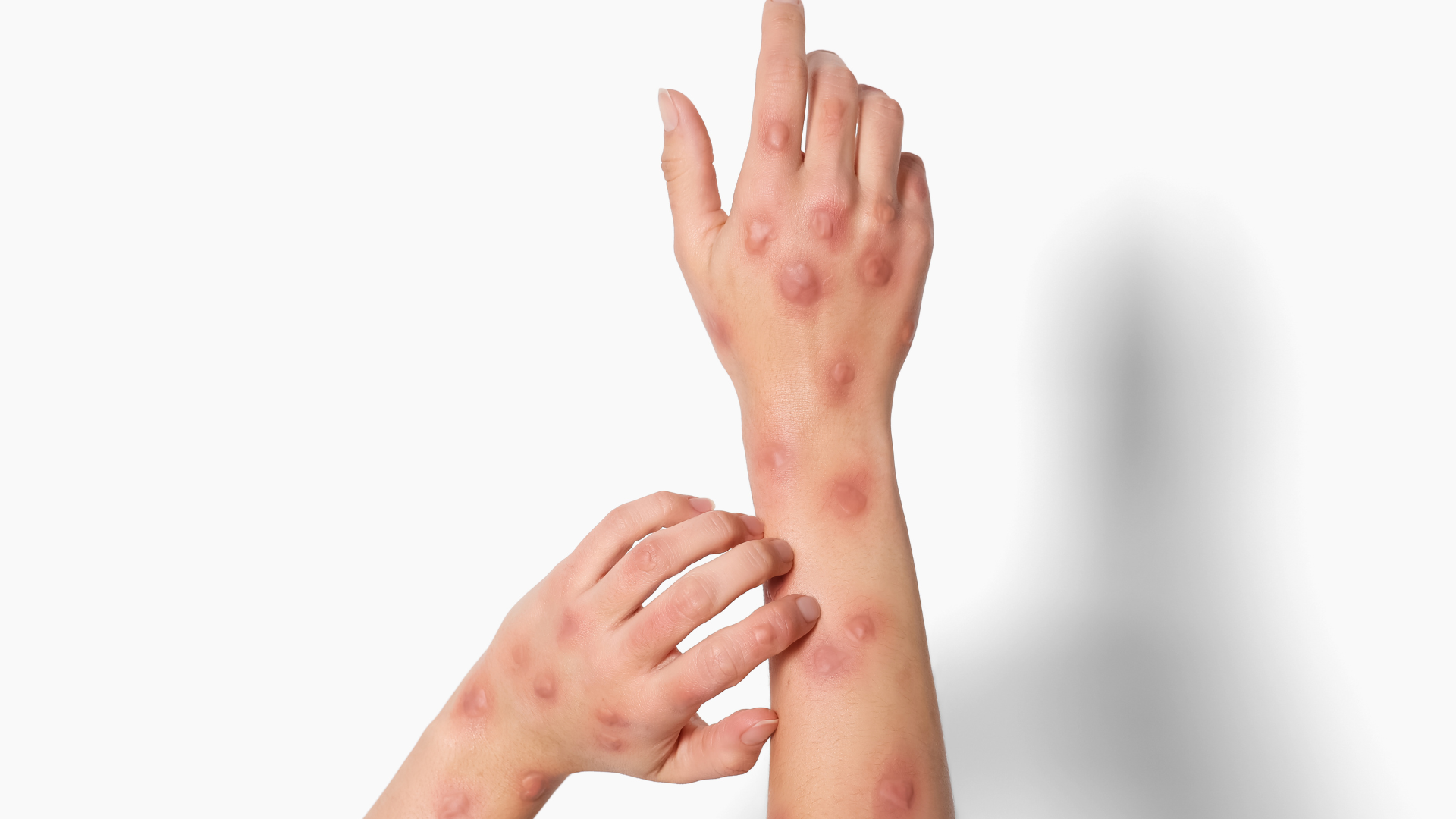A person is scratching their arm with a rash on it.