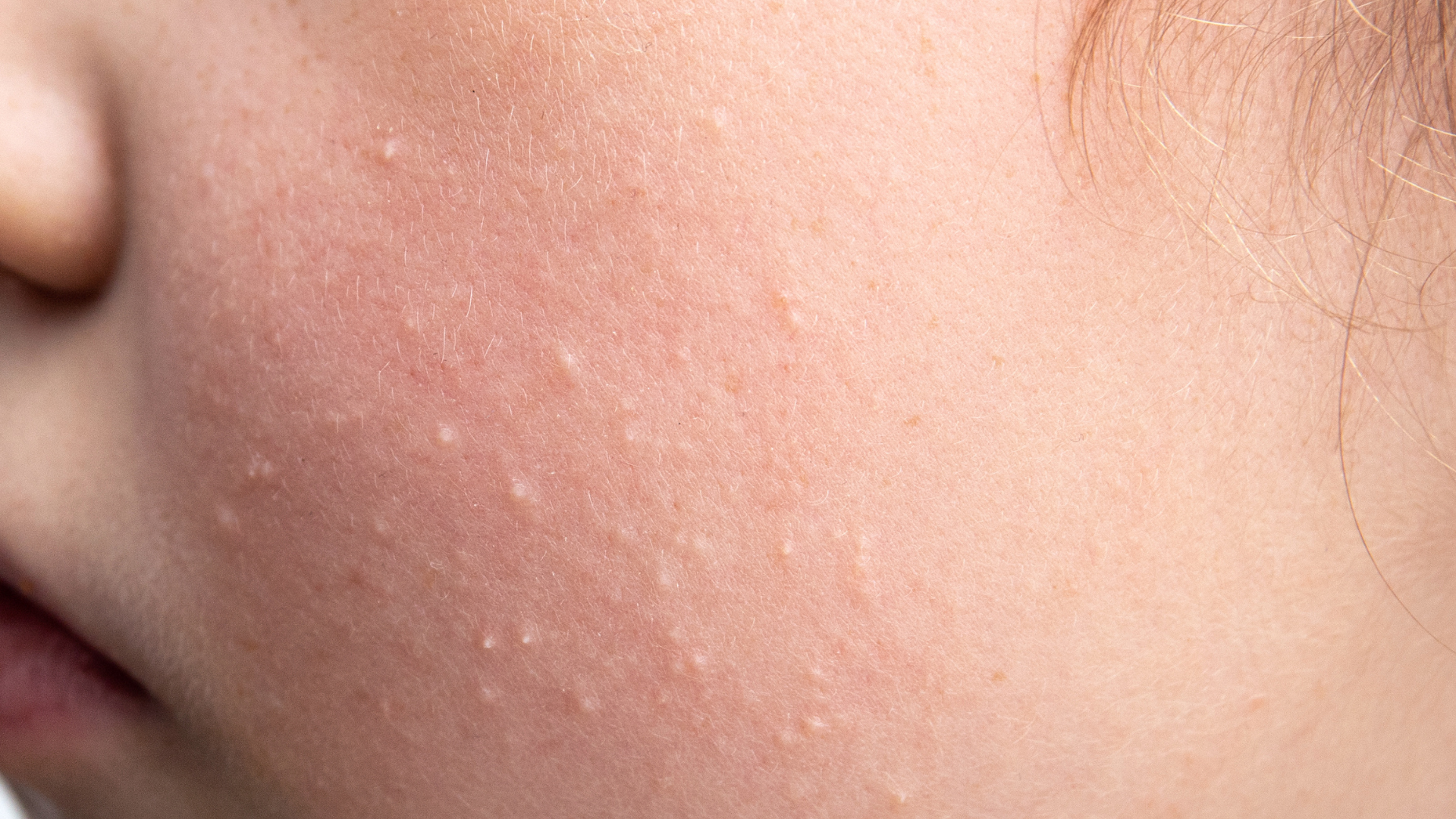 A close up of a woman 's face with white spots on it.