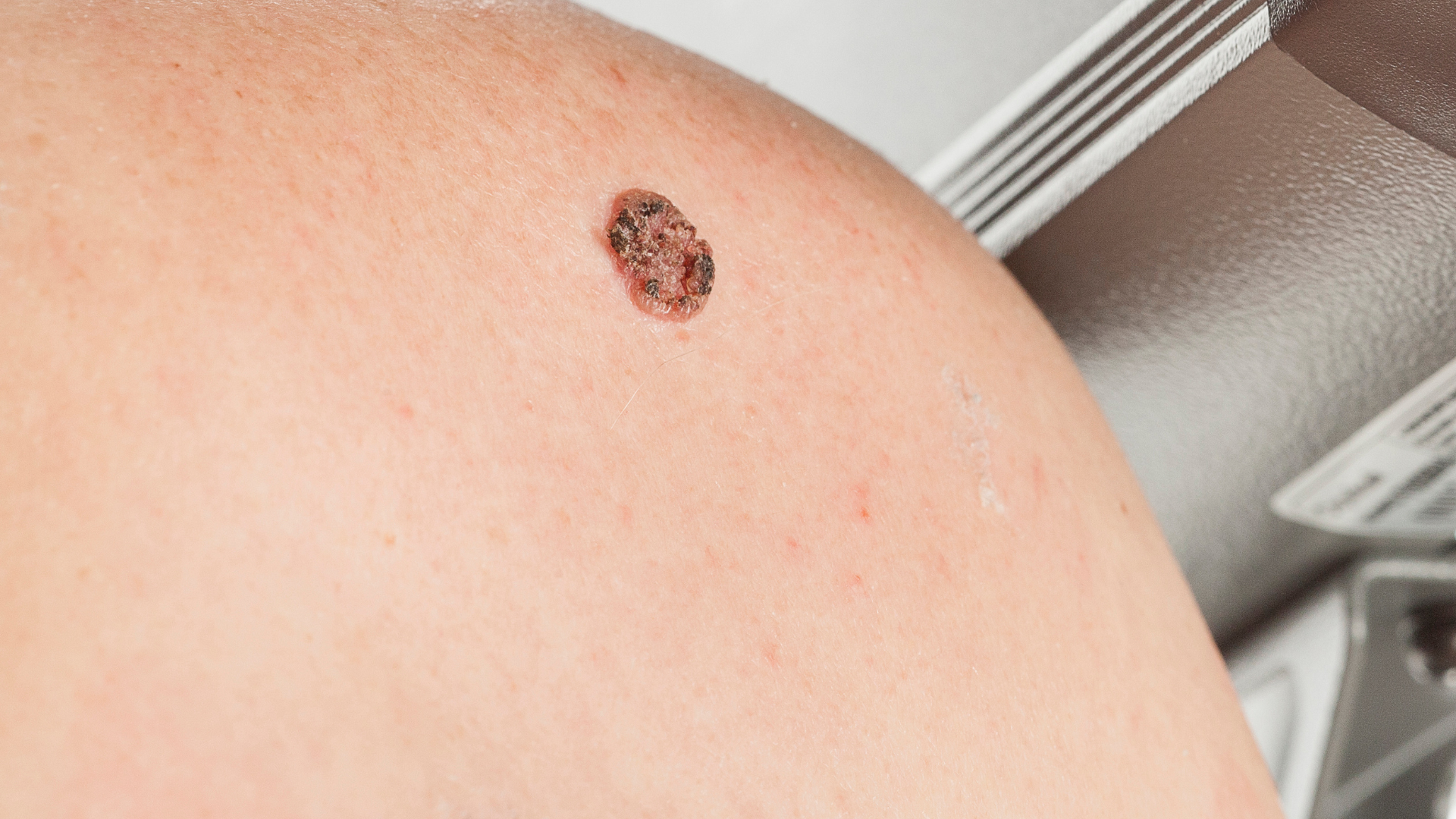A close up of a mole on a person 's shoulder.