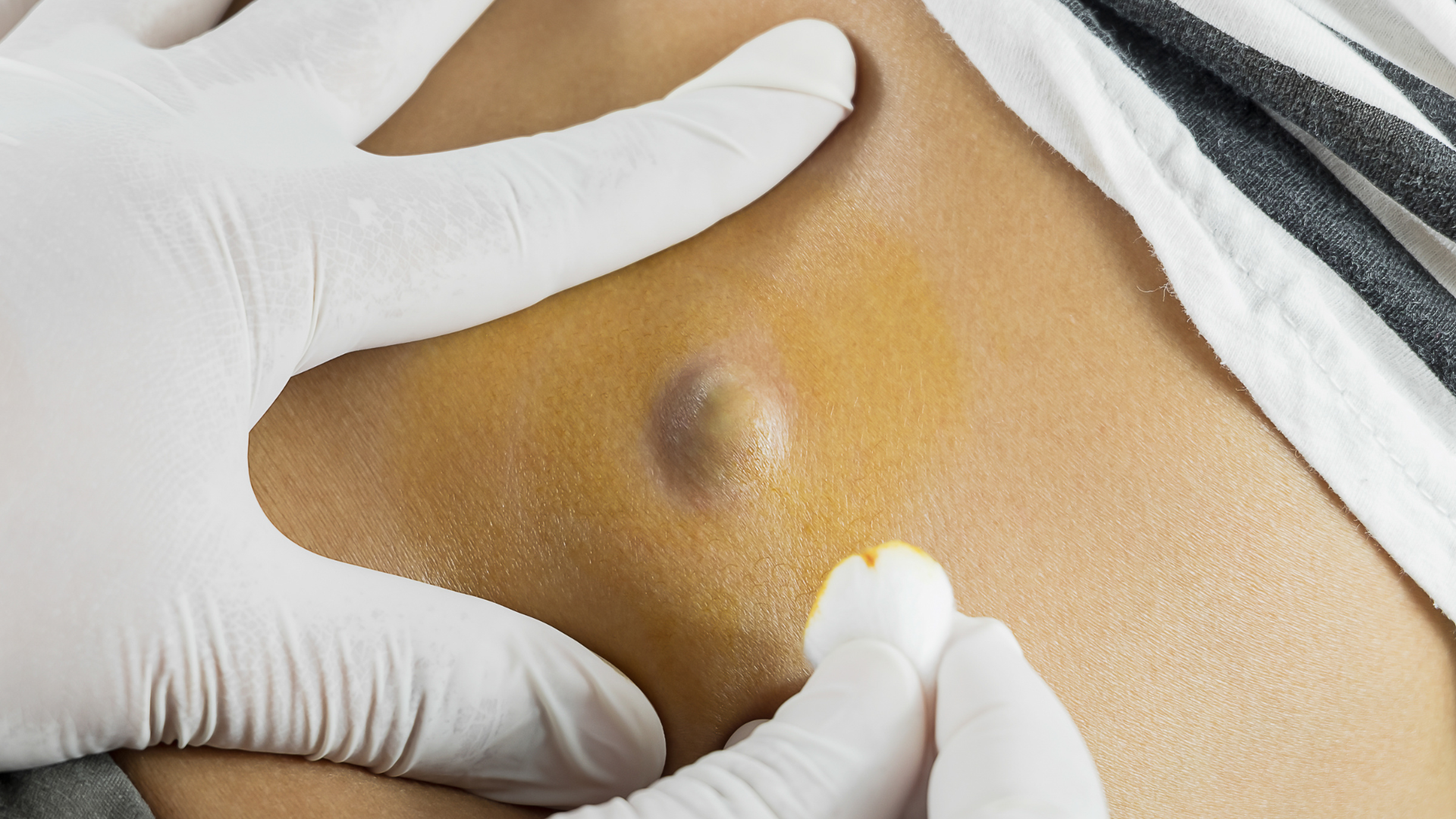 A person is being examined by a doctor for a lump on their stomach.