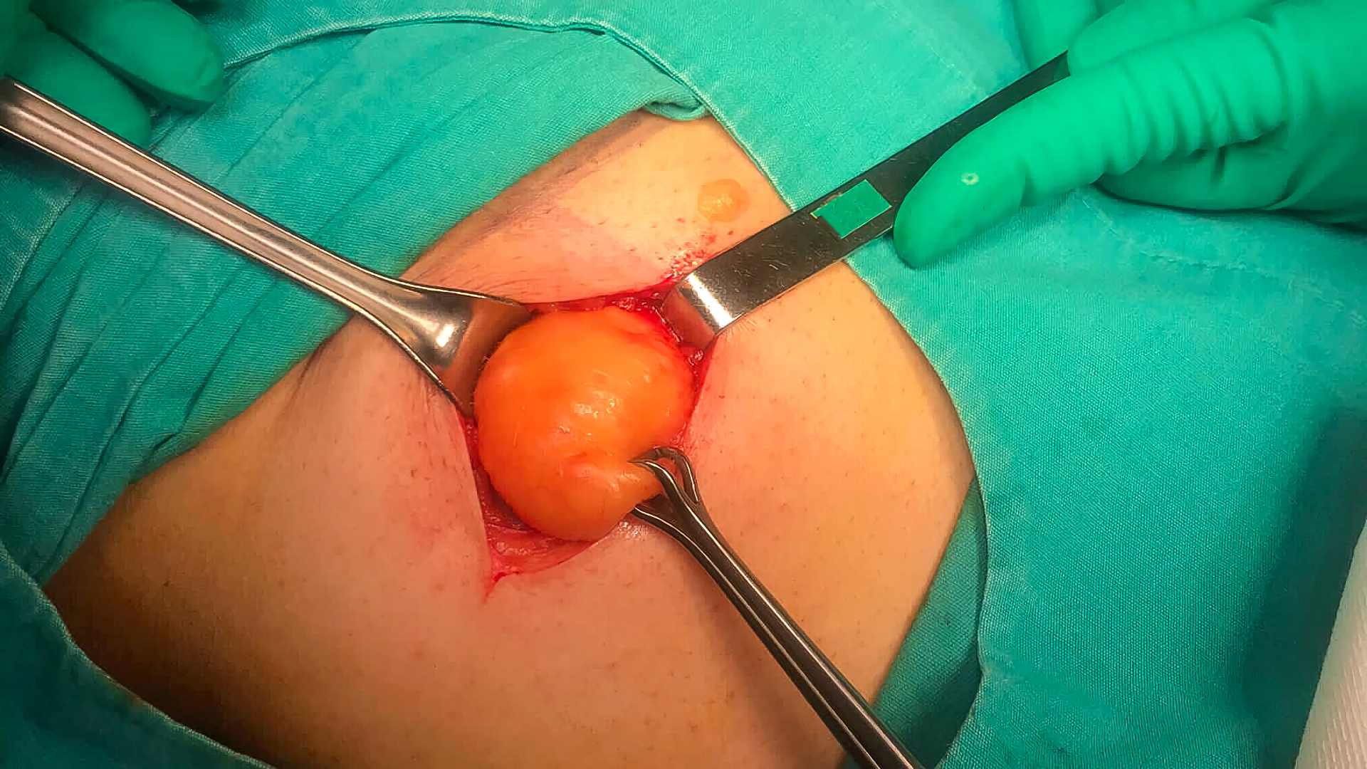 A surgeon is operating on a patient in an operating room.