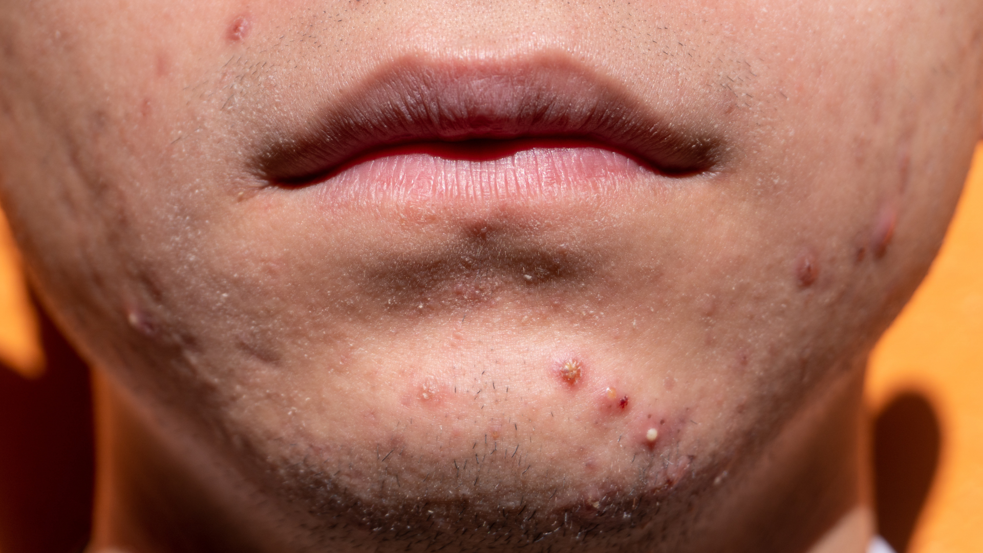 A close up of a man 's face with acne on it.