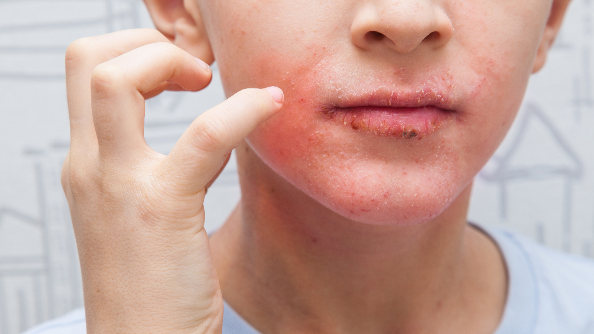 A close up of a person 's face with a rash on it.