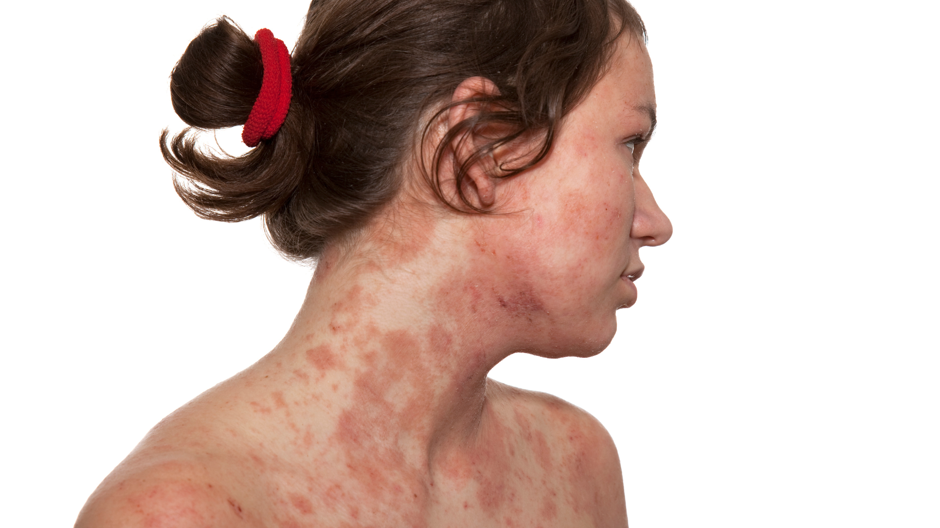 A woman with red spots on her face and neck.