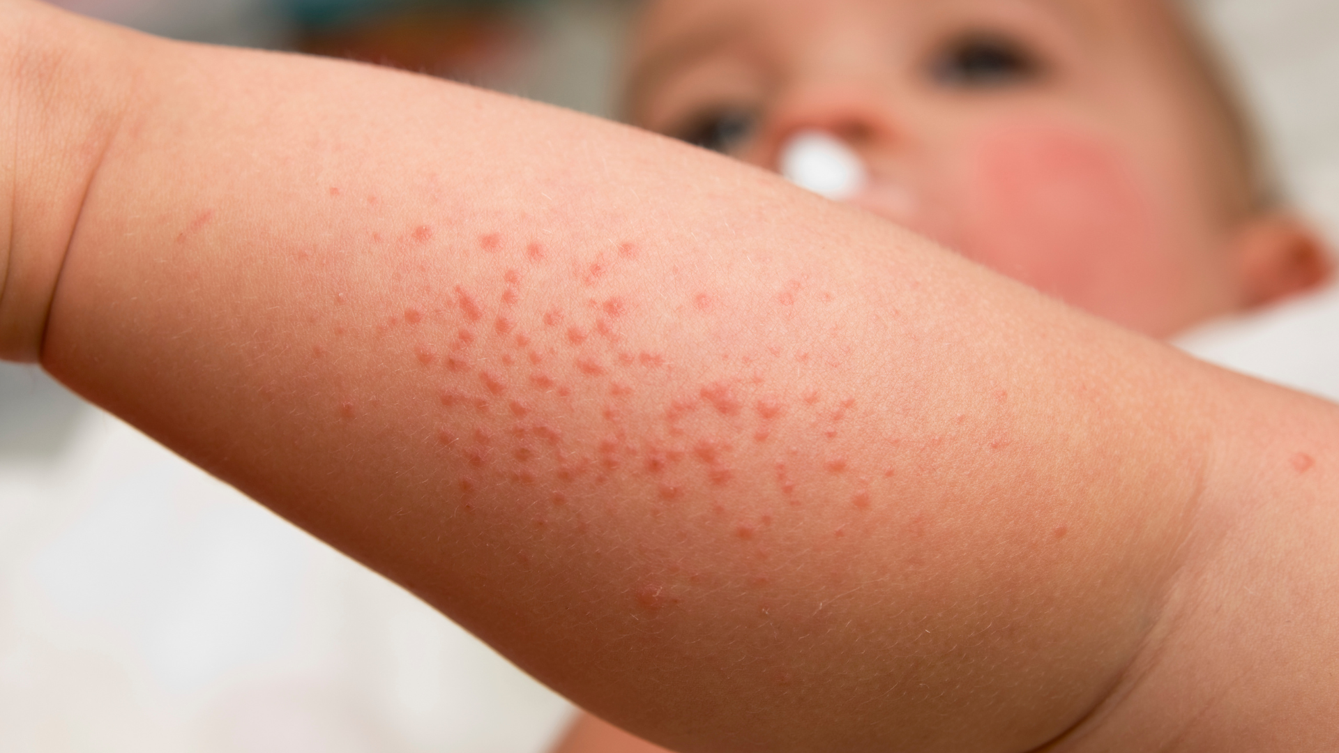 A close up of a baby 's arm with red spots on it.