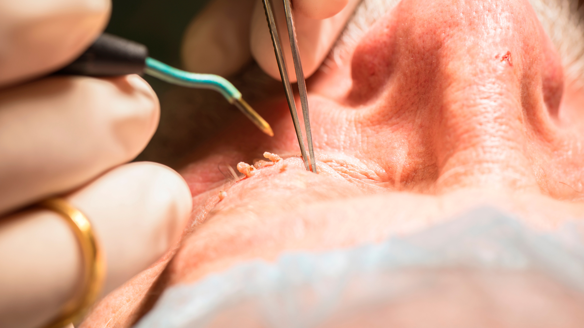 A close up of a person getting a wart removed from their nose.
