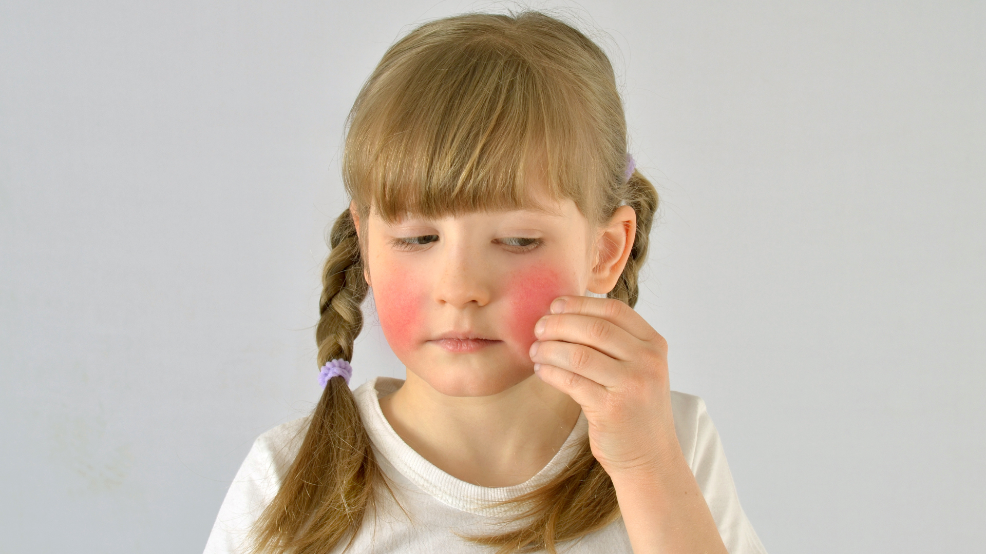 A little girl has red spots on her face.