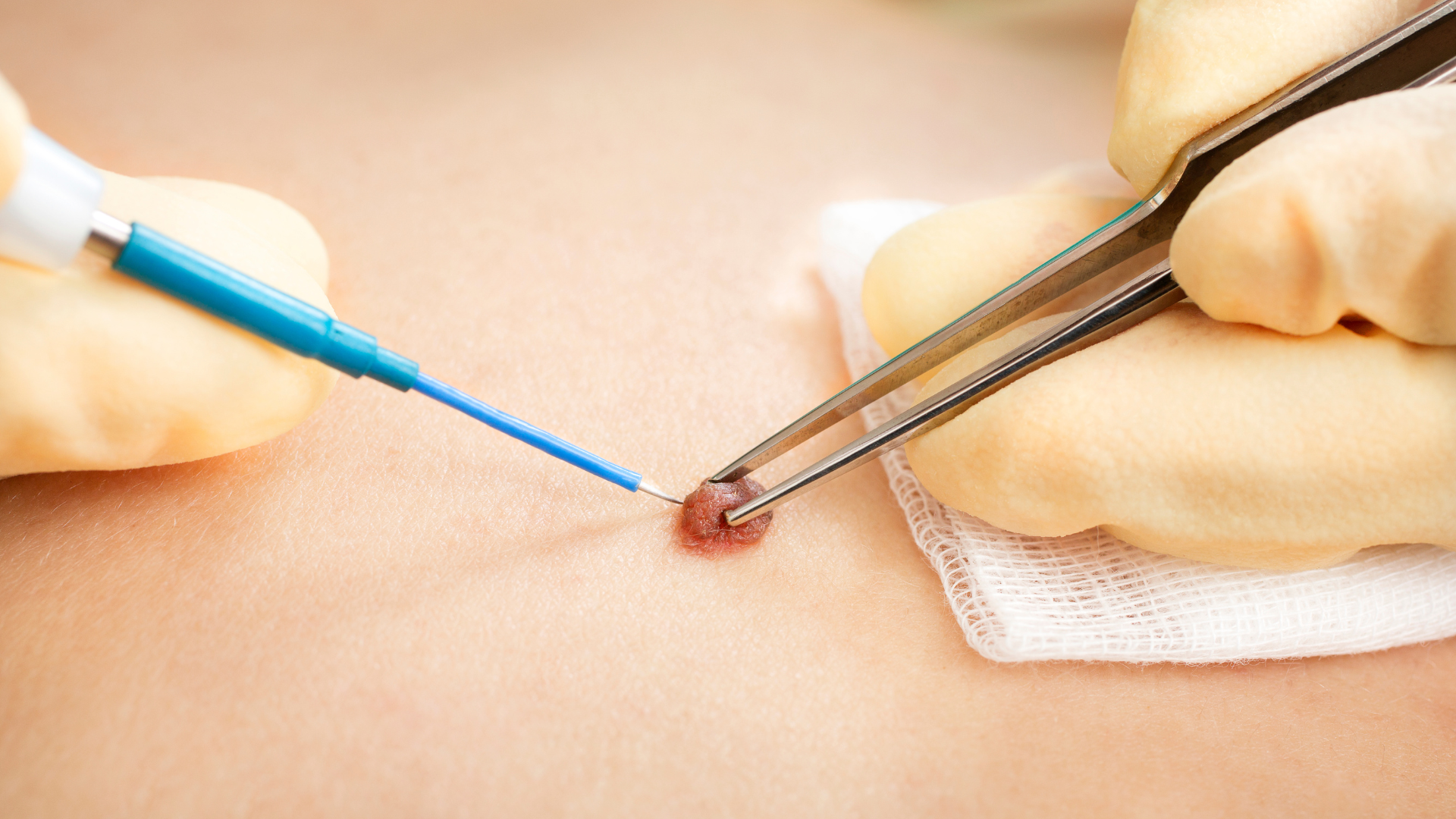 A person is using tweezers to remove a mole from a person 's skin.