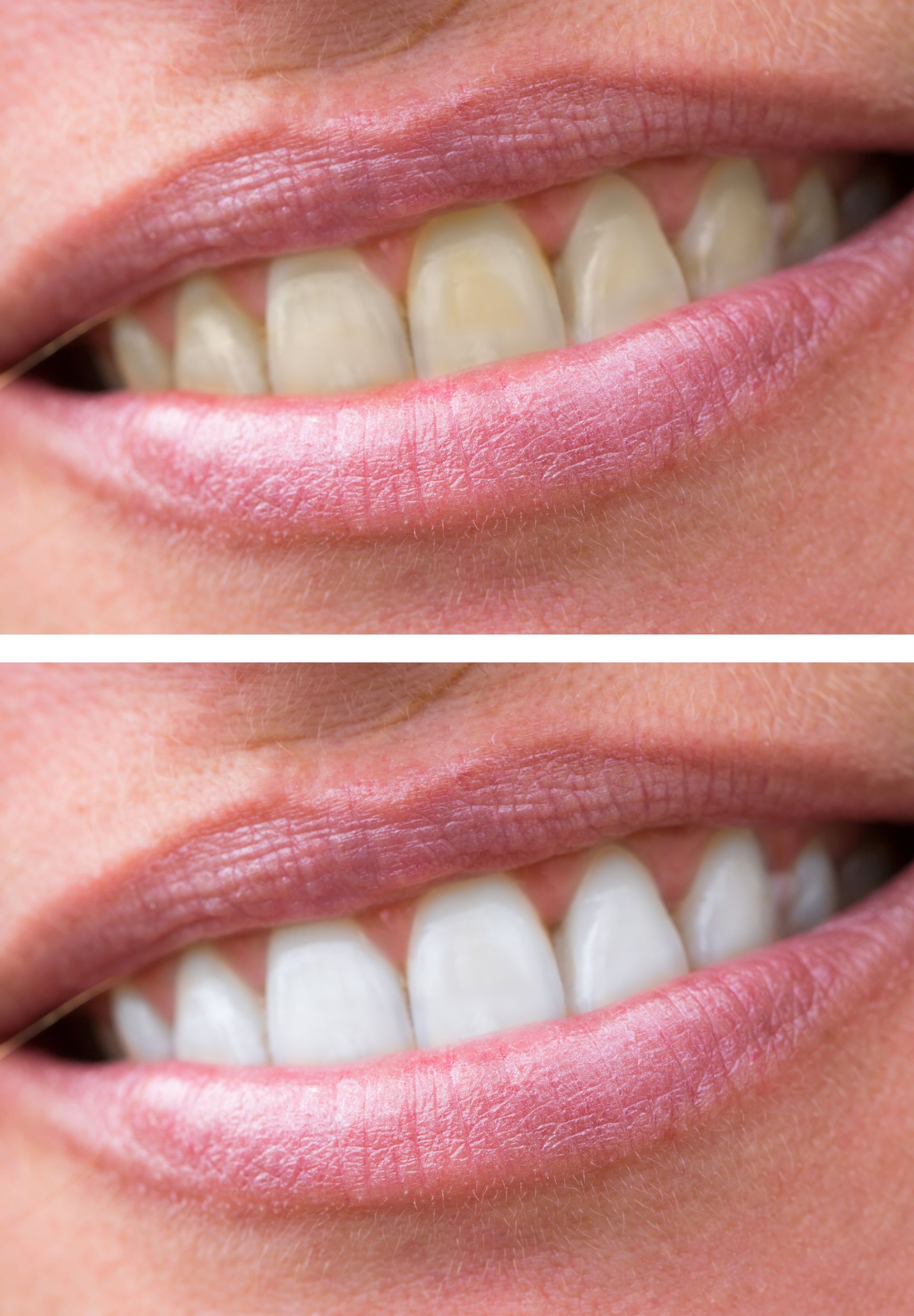 Before and after of a woman's teeth whitening treatment at Randal P. Ashton, DDS, in Danville, IL