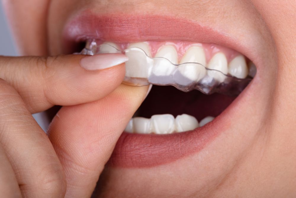 A Hand Inserts a Clear Plastic Dental Aligner Over a Person's Upper Teeth — Mareeba Dental Centre in Mareeba, QLD
