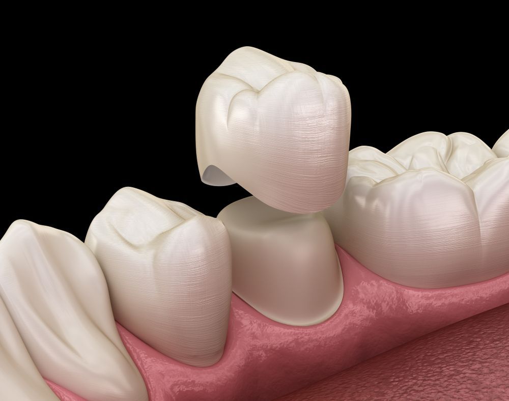 Dental Mold Being Fitted to a Smiling Mouth With a Gloved Hand Holding the Tool — Mareeba Dental Centre in Mareeba, QLD
