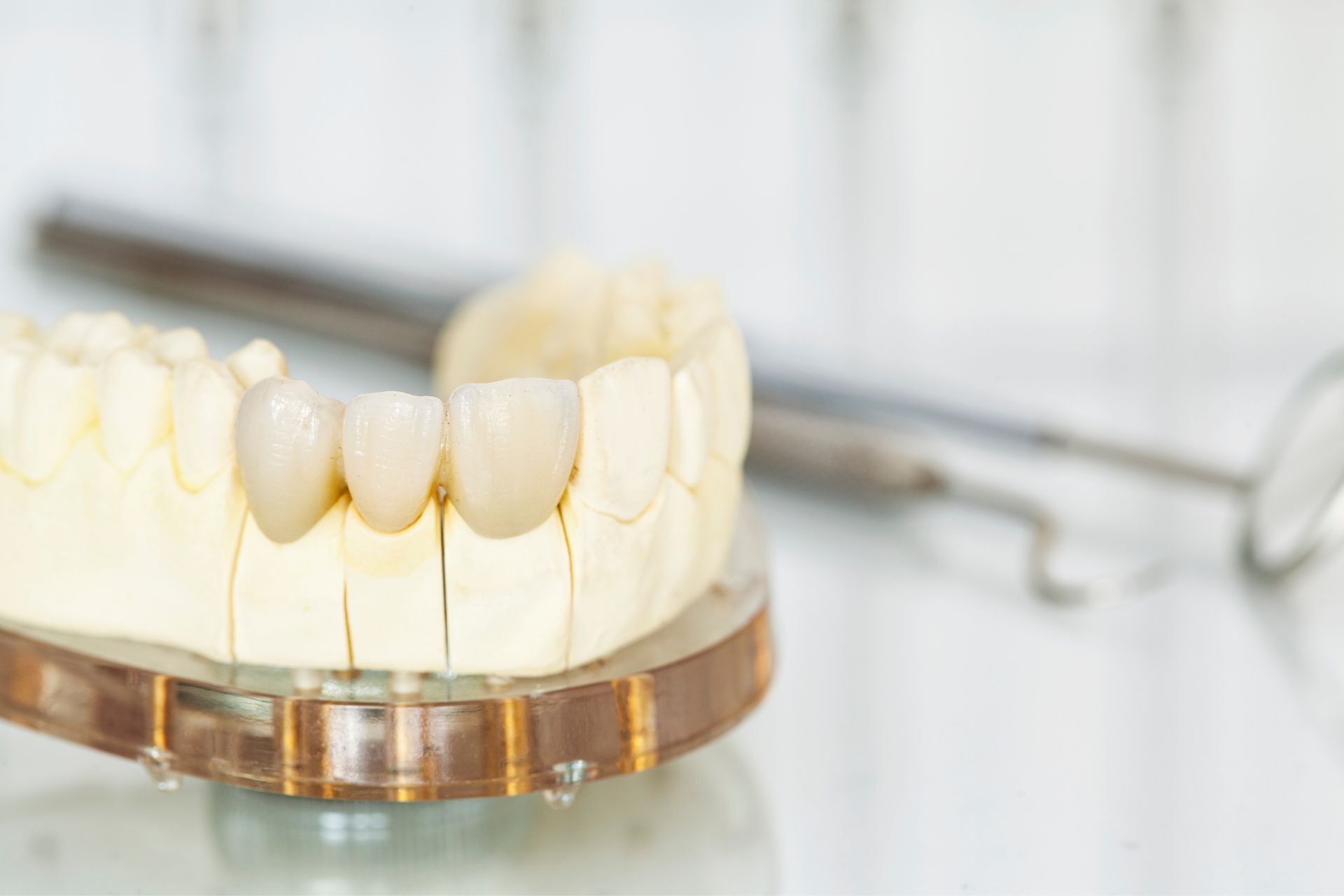 Advantages of a crown | Bellwood family Dental