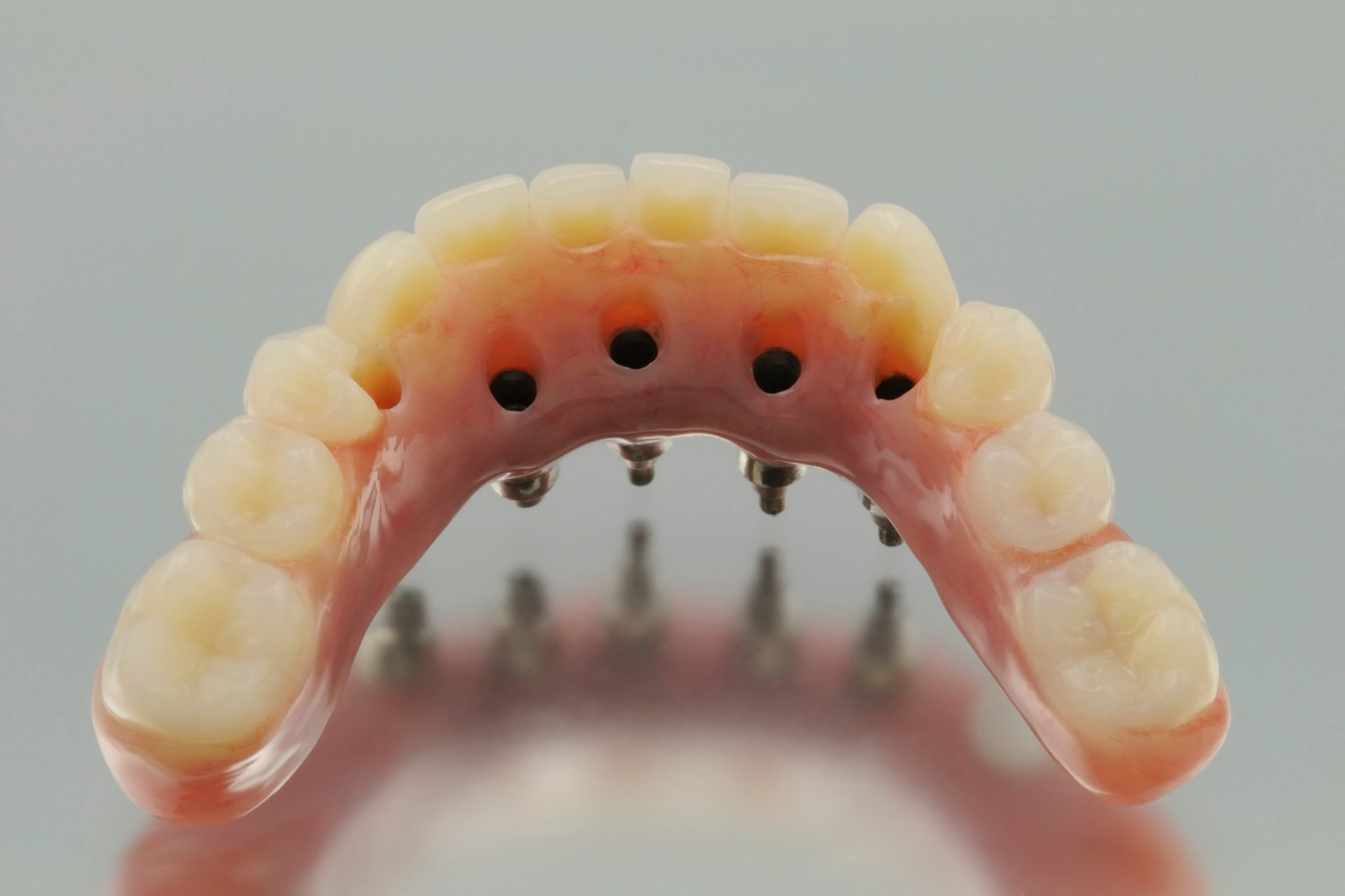 denture implants near East Alton, IL | Bellwood Family Dental