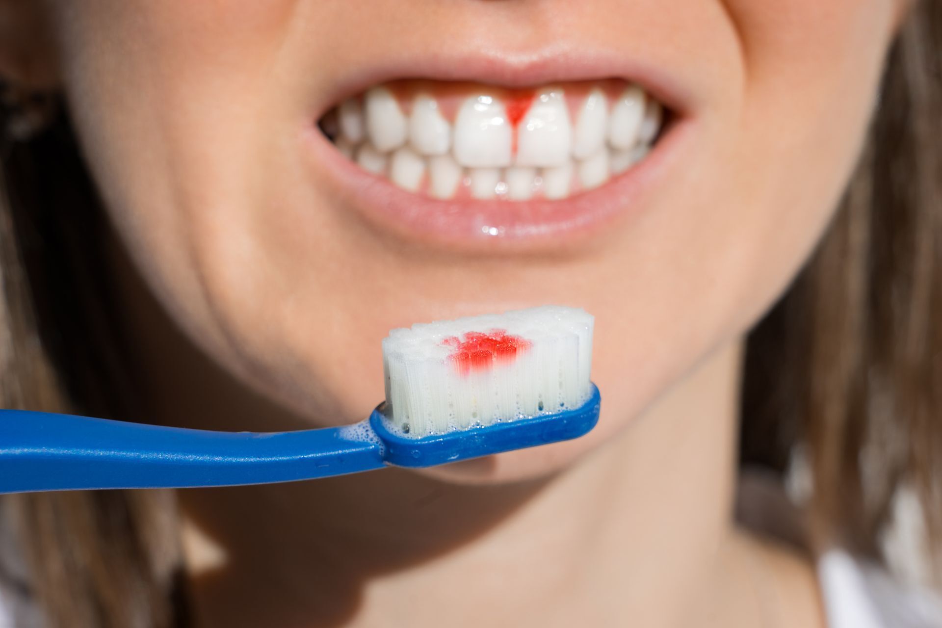 Periodontal Disease | Bellwood Family Dental