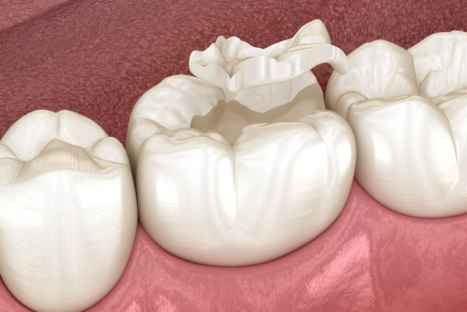 Dental Sealants and Treatment | East Alton, IL
