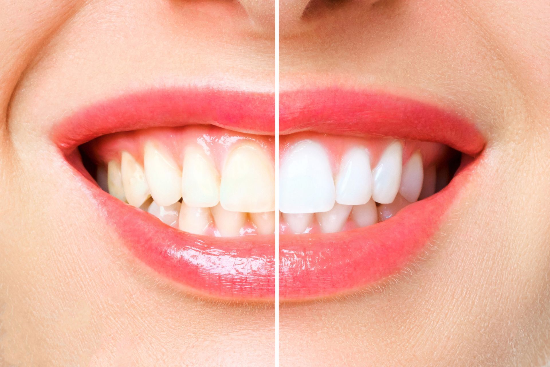 Teeth Whitening services at Bellwood Family Dental