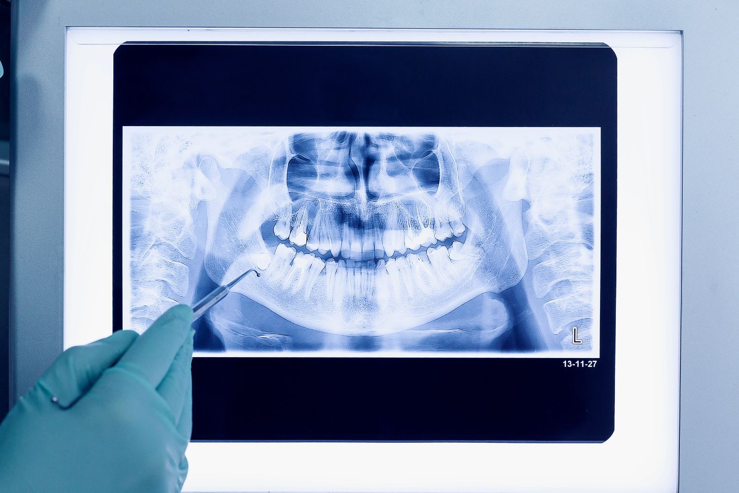 Dental X-Rays | East Alton, IL
