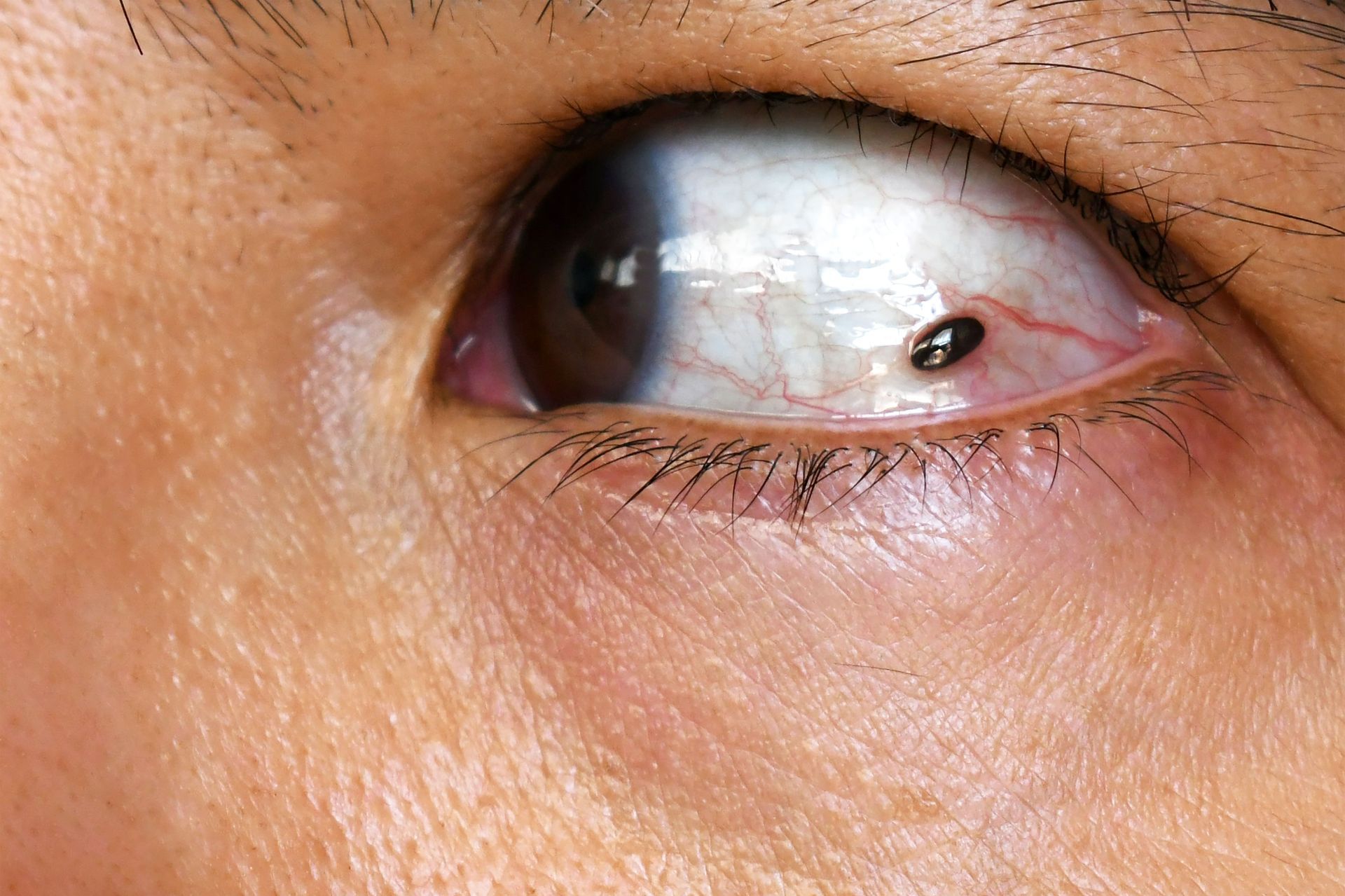 melanoma ocular