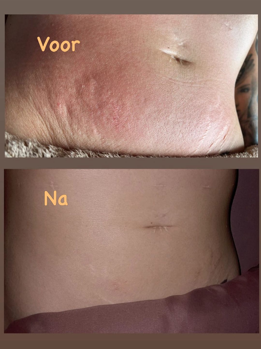 Striae cupping