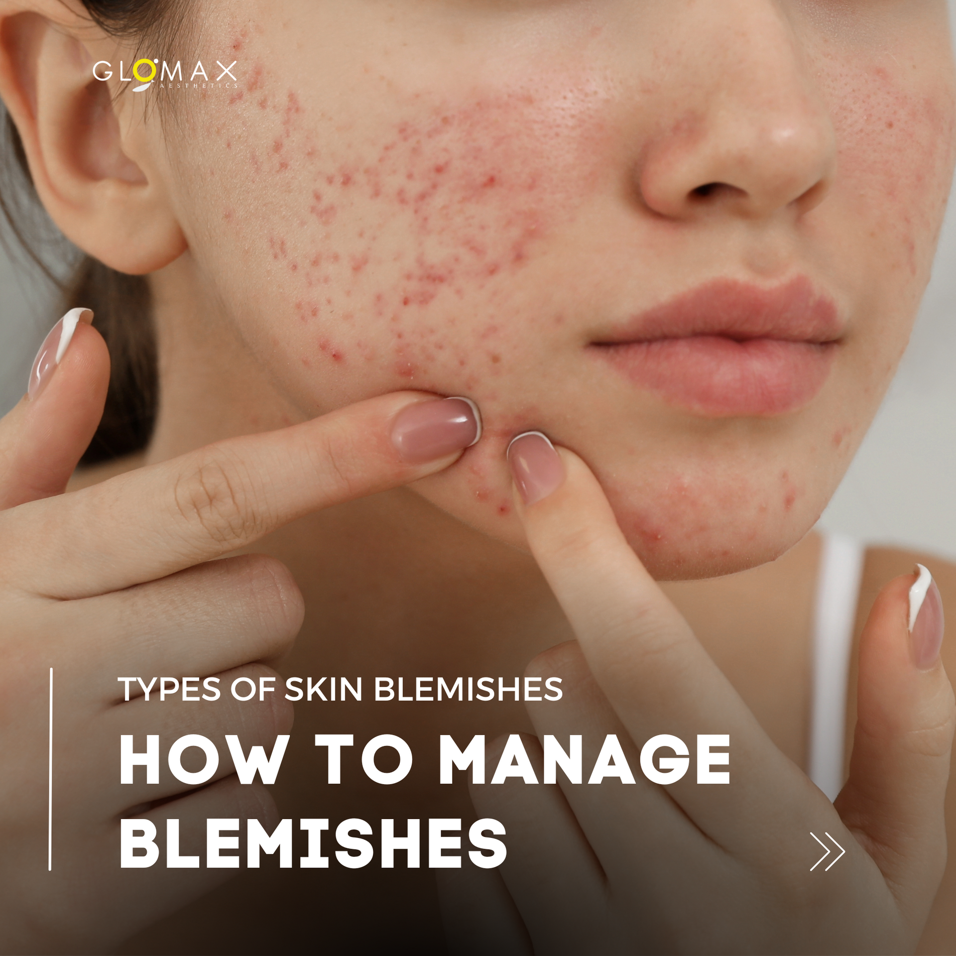 Book your first trial for acne facial treatment in Singapore at Glomax Aesthetics for only $89.