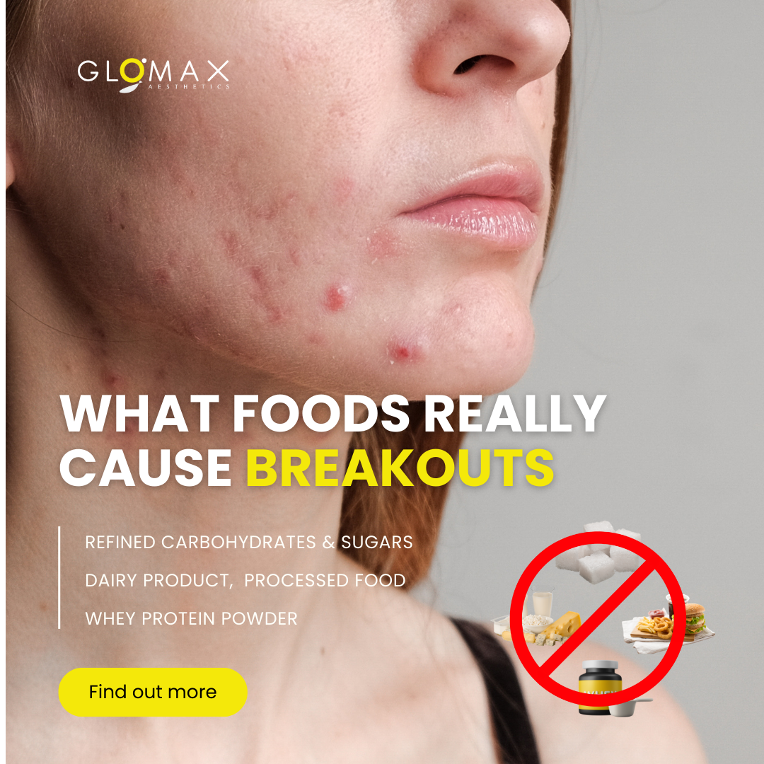 What Foods REALLY Cause Breakouts?
