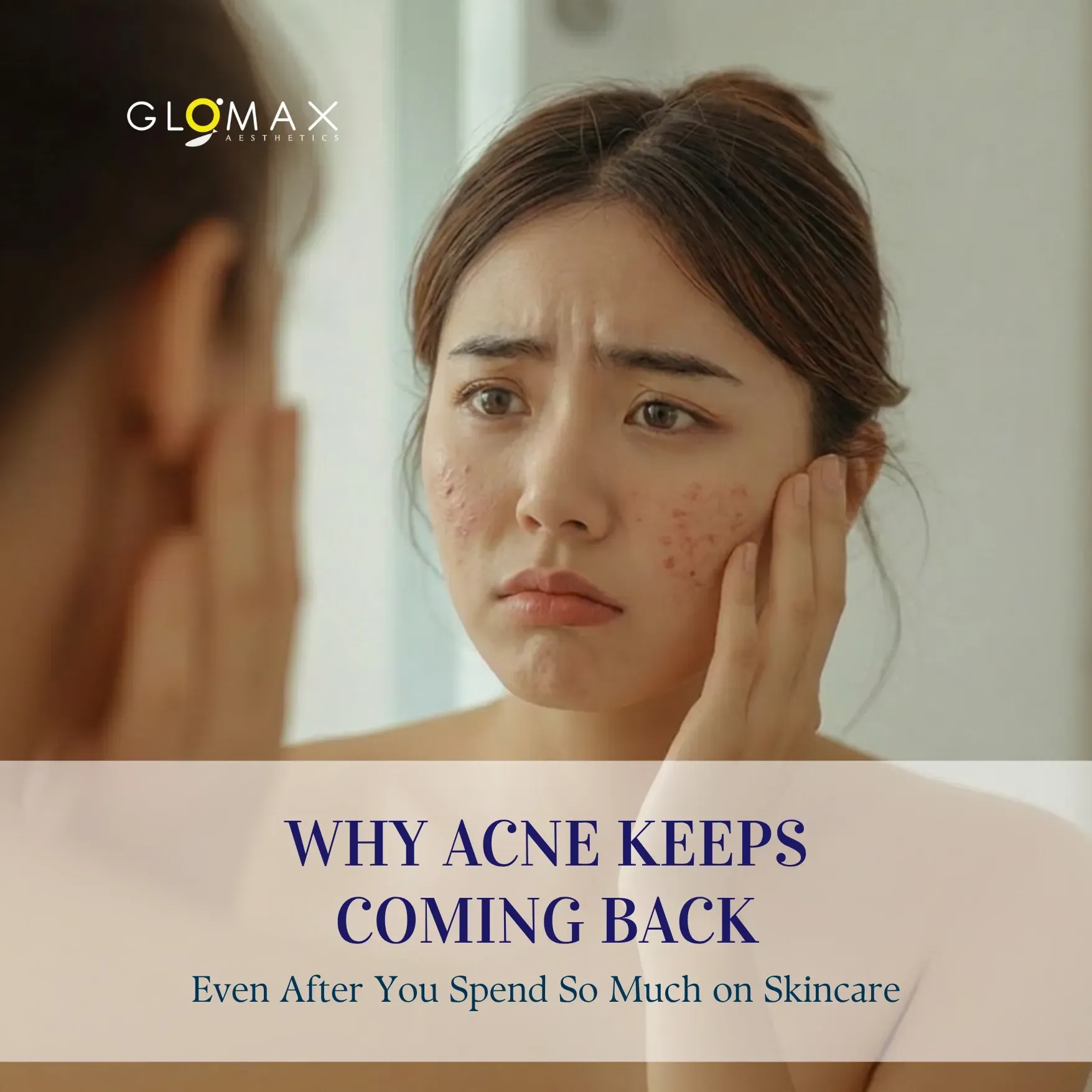 Why Acne Keeps Coming Back — Even After You Spend So Much on Skincare