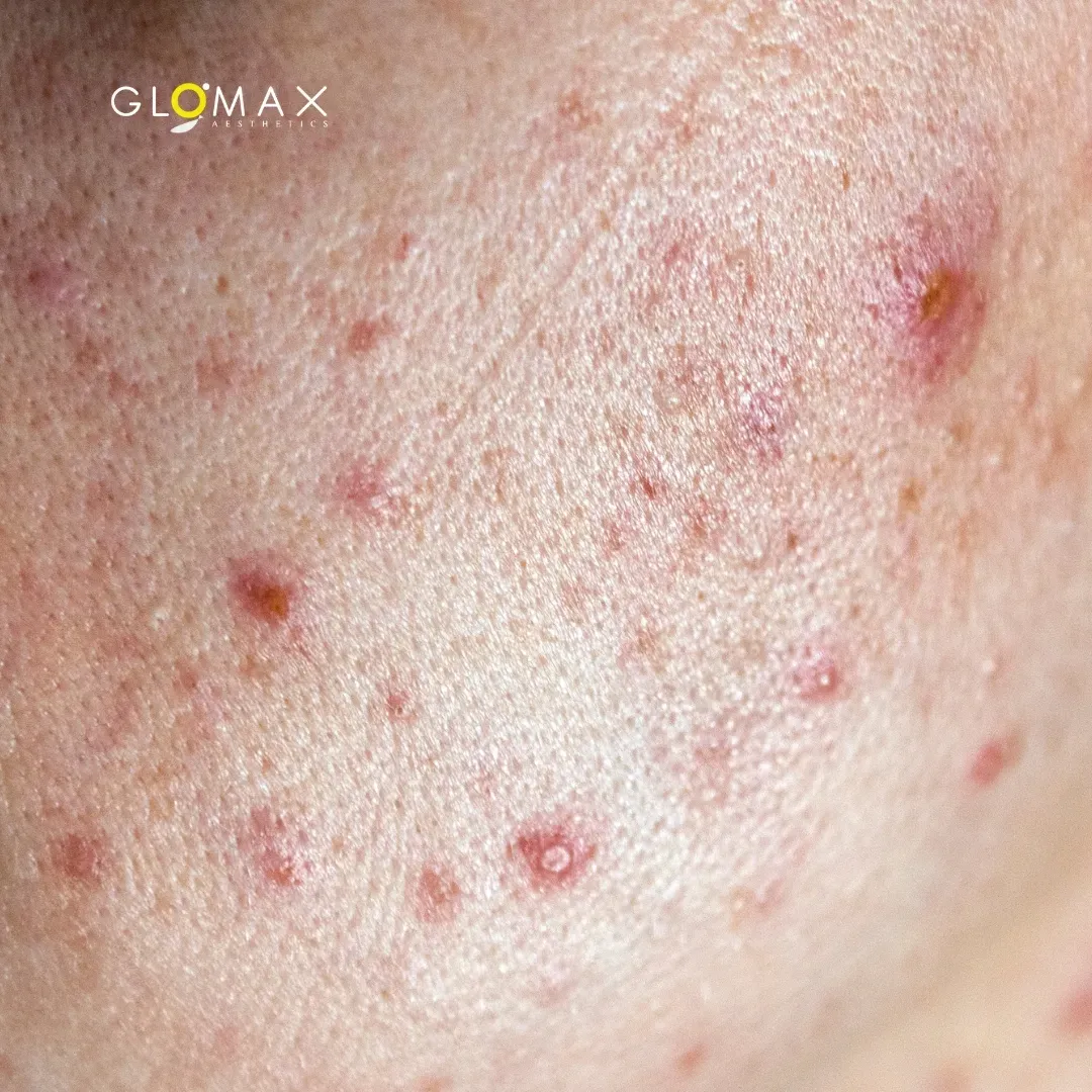 Acne Scarring