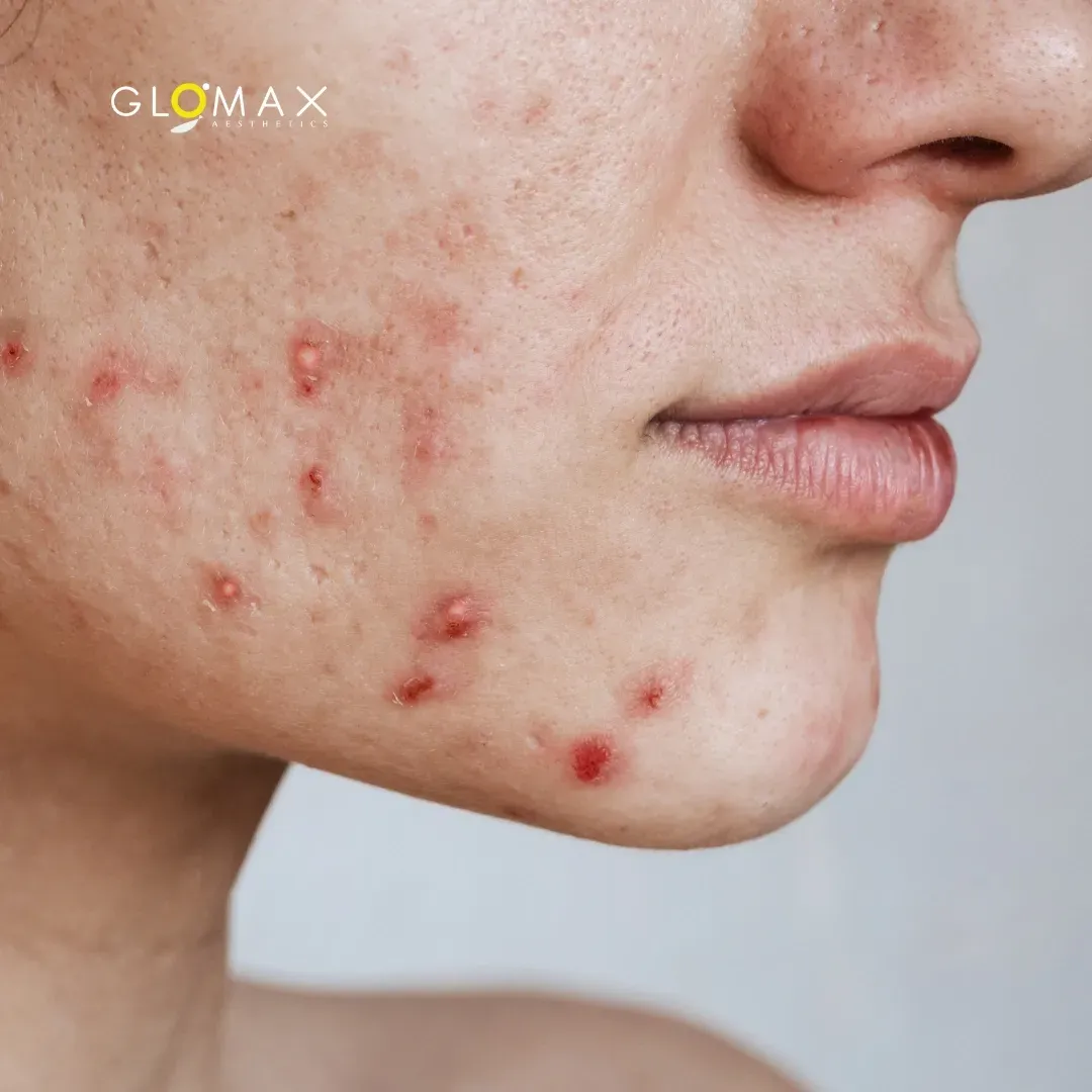 What Really Causes Acne? (Hint: It’s Not Just Oil)