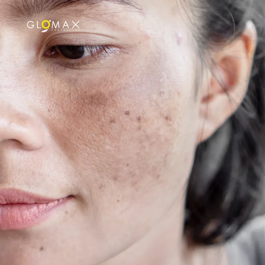 Pigmentation