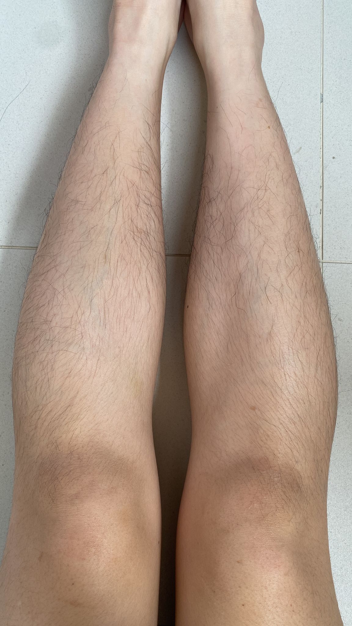 Glomax Aesthetics - BBL Hair Removal Treatment