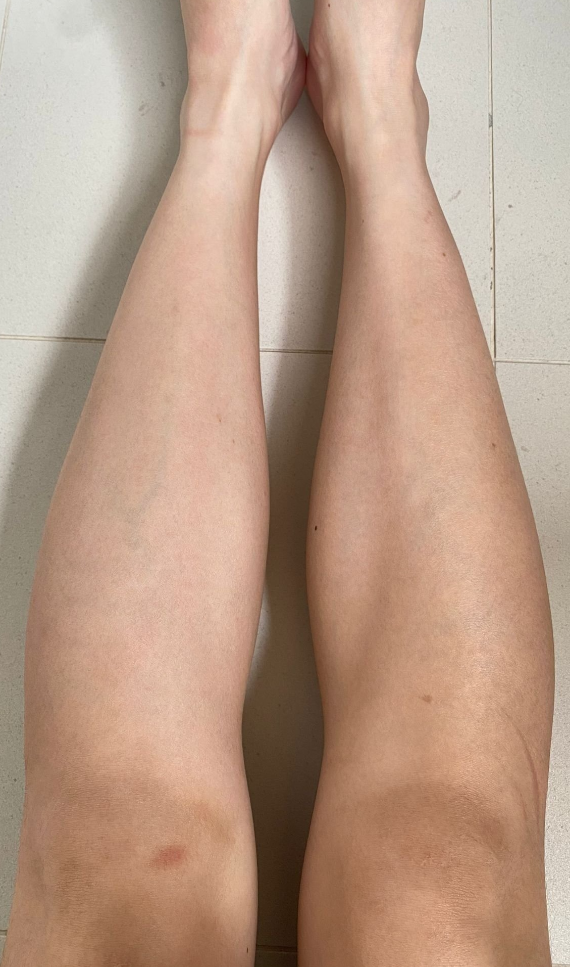 Glomax Aesthetics - BBL Hair Removal Treatment