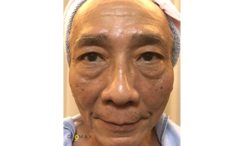 Glomax Aesthetics - WishPro MIT Repairing Treatment